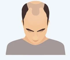 Stage 4